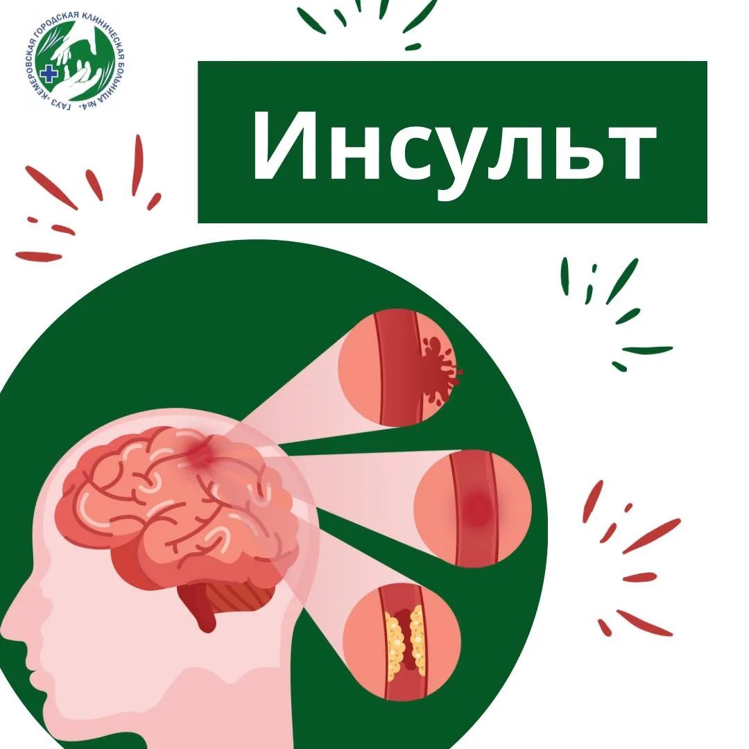 Инсульт: быстрые действия могут спасти жизнь!